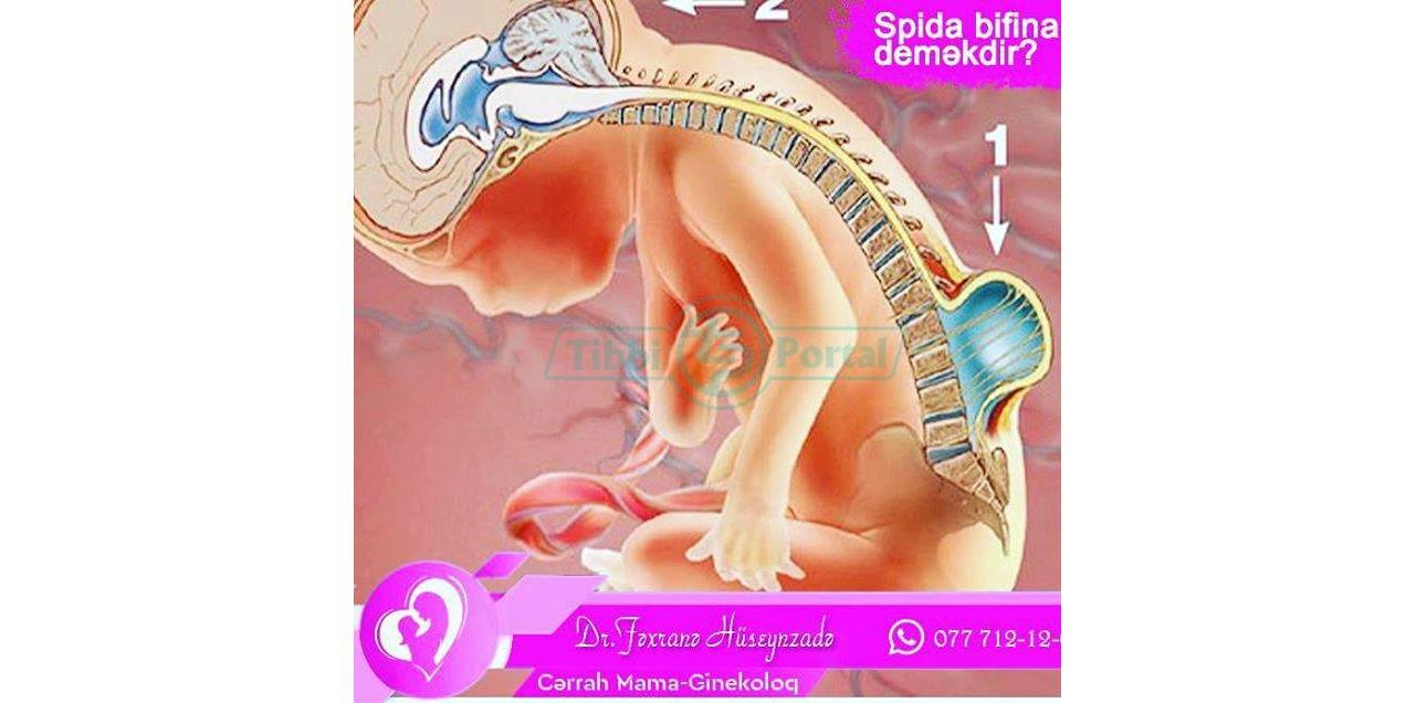 Spina – bifida nə deməkdir?