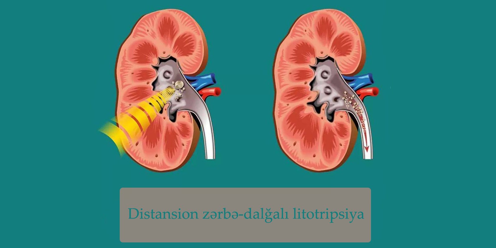 Distansion zərbə-dalğalı litotripsiya