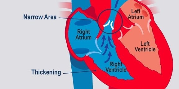 Pulmonar Stenoz, ağciyər damarında darlıq